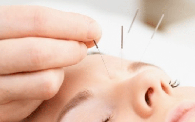 COSMETISCHE-ACUPUNCTUUR
