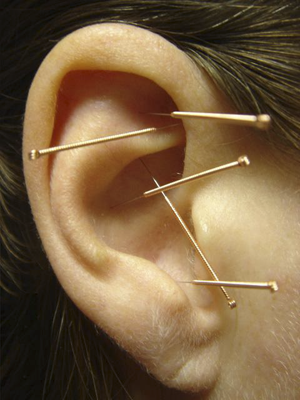 auricular-acupuncture_full